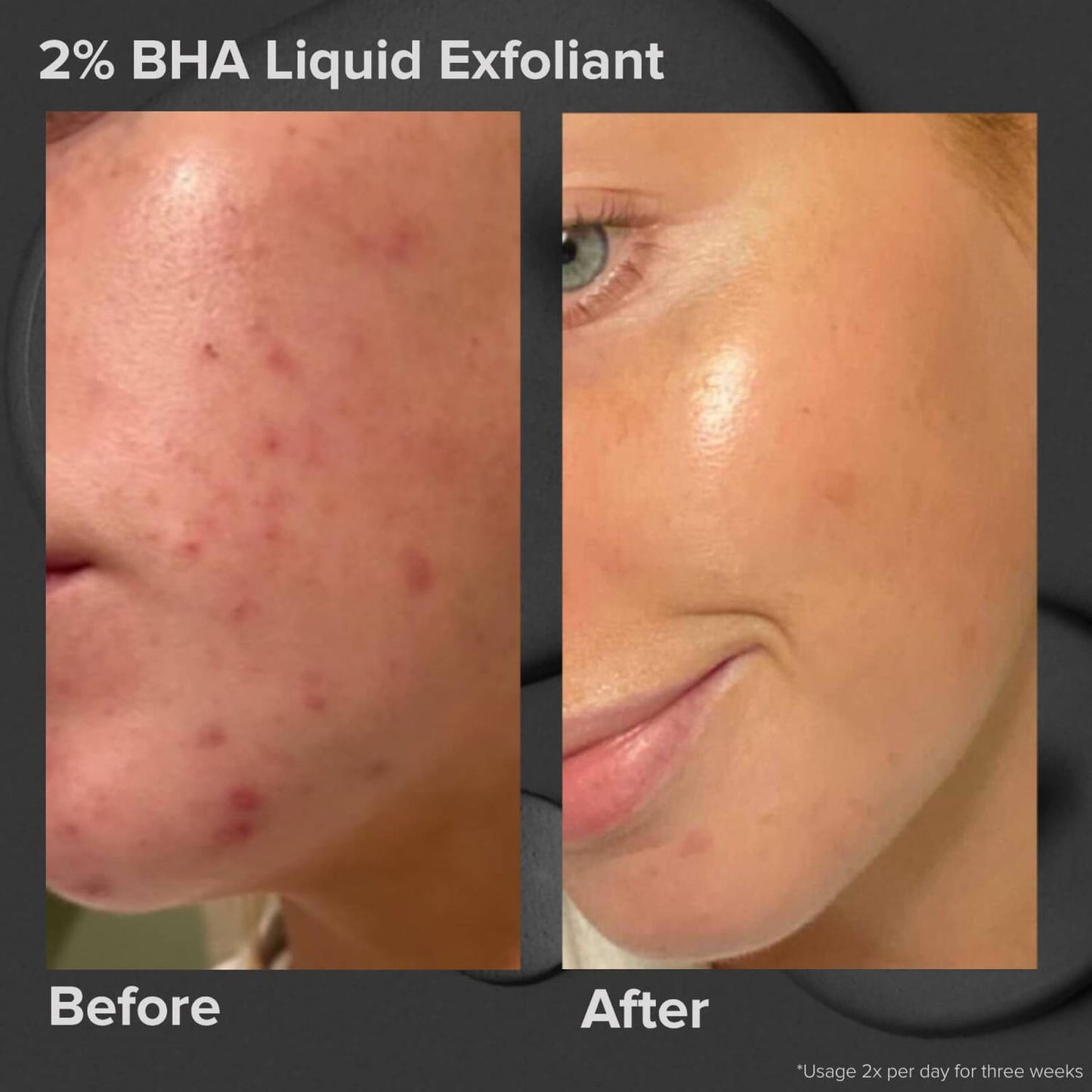 Ексфоліант Paula's Choice Skin Perfecting 2% BHA Liquid Exfoliant